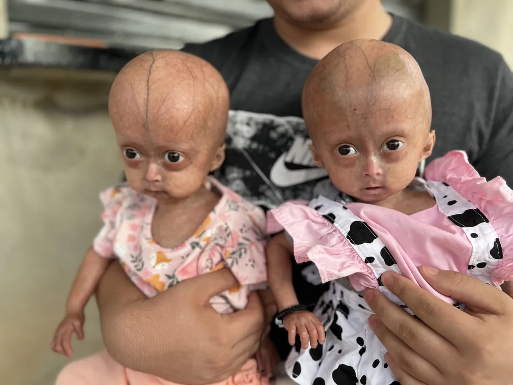 Irmãs são diagnosticadas com síndrome rara da velhice precoce em RR e esse pode ser o primeiro caso em gêmeas do mundo